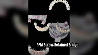 Precyzyjna odbudowa implantu przykręcana PFM