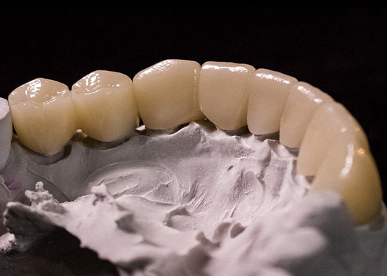 kupować Porcelana stopiona do metalowych koron - zaawansowana technologia pozwalająca na długotrwały powrót do uśmiechu online manufacture
