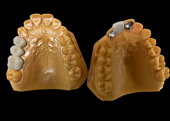 kupować Porcelana o umiarkowanej przejrzystości stopiona z metalu PFM Crown, PFM Ceramic Crown online manufacture