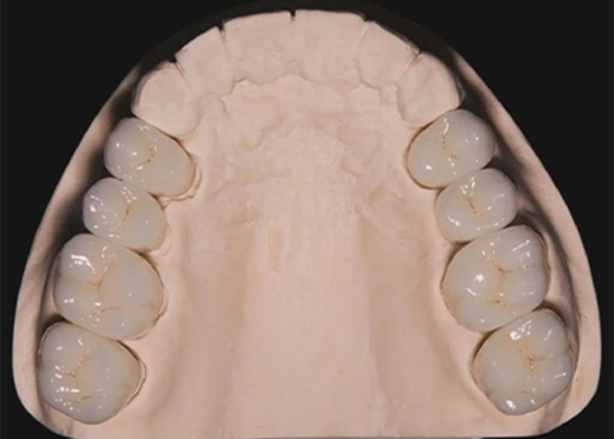 kupować Zęby Zirkonia korony stomatologiczne wykonane przez chińskie laboratorium stomatologiczne online manufacture
