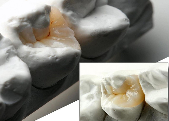 kupować Naturalnie wyglądające ceramiczne wkładki i wkładki do precyzyjnej restauracji zębów z naszego eksperckiego laboratorium stomatologicznego online manufacture