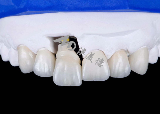 kupować Korona implantów z titanowym podłożem dla naturalnego uśmiechu online manufacture