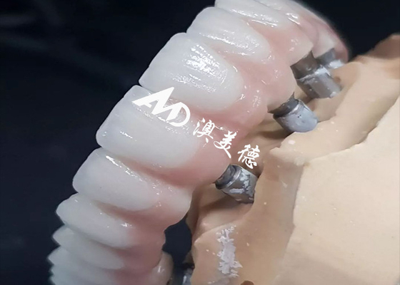kupować Ekskluzywny wysokiej wydajności implant zębowy most koronowy różne rozmiary dostępne online manufacture