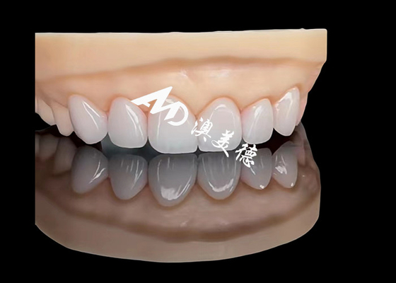kupować Porcelan EMAX Veneer Wysokiej Precyzji Restauracje estetyczne z wyższą trwałością online manufacture