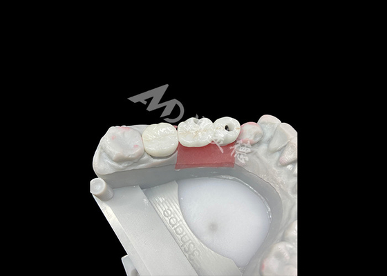 kupować Korony z implantów stomatologicznych z cyrkonii z titanowym podłożem dla zwiększonego komfortu i estetyki online manufacture