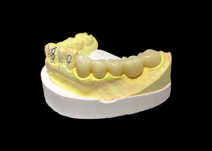 Wysokiej klasy cyrkonium porcelanowe korony dentystyczne Bezkonkurencyjna wytrzymałość Precyzja dopasowanie i wyjątkowa estetyka i trwałość