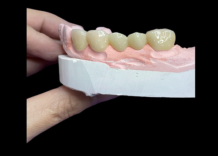 Wszystkie ceramiczne korony i mosty zaprojektowane z myślą o wyższej estetyce, trwałości i naturalnym dopasowaniu do długotrwałej pewności siebie