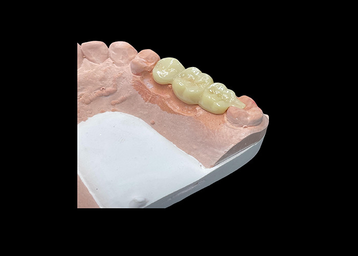 Naturalna estetyka Przezroczyste ceramiczne korony do odnowy zębów z łatwym czyszczeniem i długotrwałymi wynikami