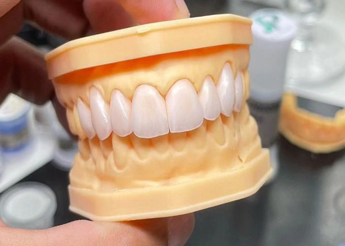 Wysokiej wytrzymałości pełny ceramiczny most koronowy z wyjątkową biologiczną kompatybilnością dla długotrwałej trwałości
