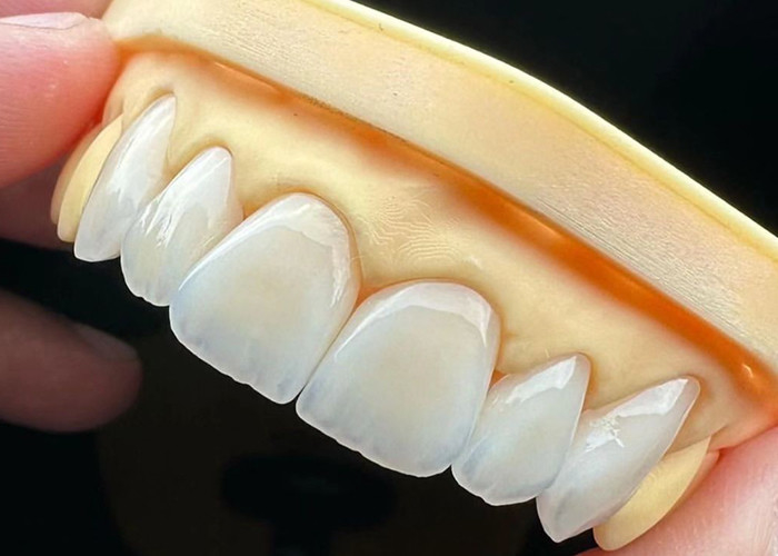 Wysokiej wytrzymałości pełny ceramiczny most koronowy z wyjątkową biologiczną kompatybilnością dla długotrwałej trwałości