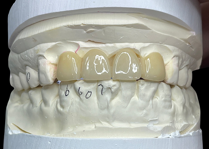 Odporny na plamy Porcelanowy most Komfortowy nadaje się do odnowy zębów