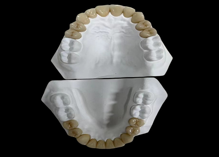 Komfortowy porcelanowy most dentystyczny z konstrukcją całkowicie ceramiczną dla wyjątkowej odporności na zużycie