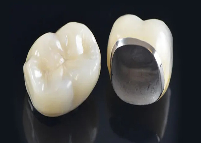 Naturalnie wyglądająca porcelana stopiona do metalowej korony do przywracania uszkodzonych zębów