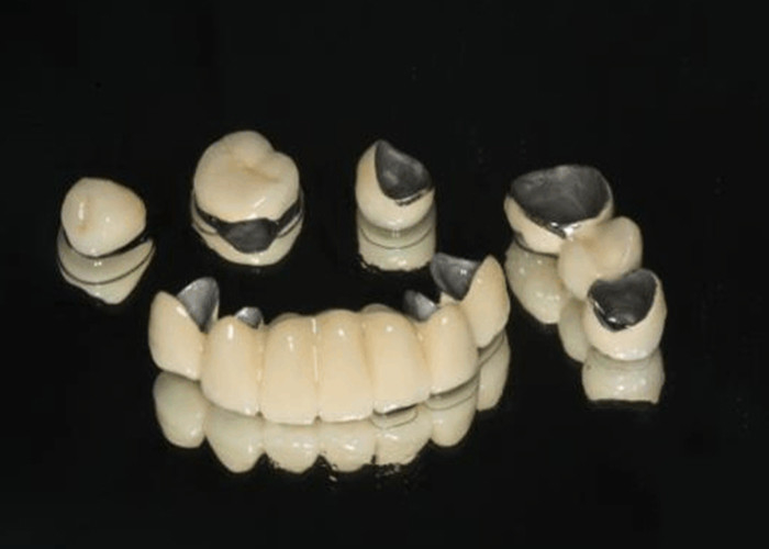 Porcelana stopiona w metalu PFM Korona odporna na zużycie stomatologiczne do odbudowy stomatologii