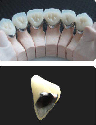Porcelana stopiona w metalu PFM Korona odporna na zużycie stomatologiczne do odbudowy stomatologii