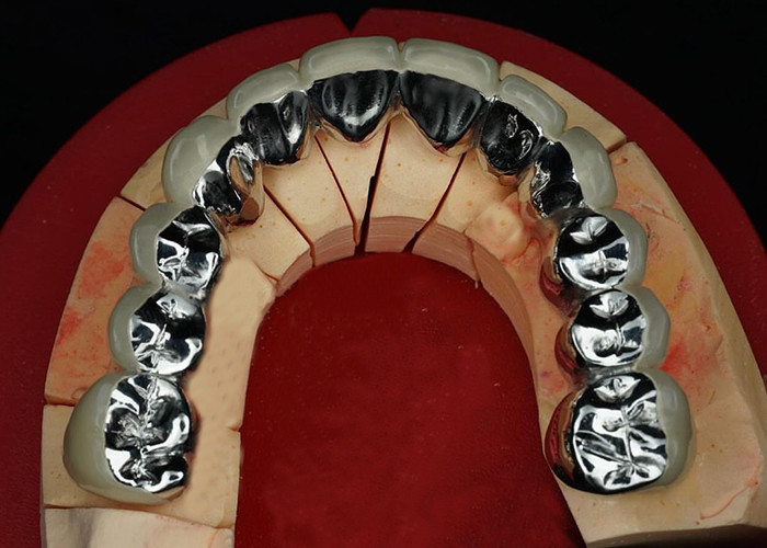 Wysoce trwała porcelana złożona z metalowej korony dla naturalnego uśmiechu