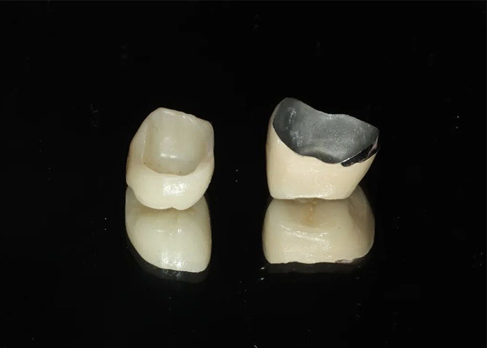 Wysoce trwała porcelana złożona z metalowej korony dla naturalnego uśmiechu