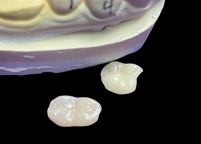 IPS e.max Ceramic Inlays and Onlays for Molar Restoration Naturalna estetyka i wyższa trwałość dla długotrwałych wyników