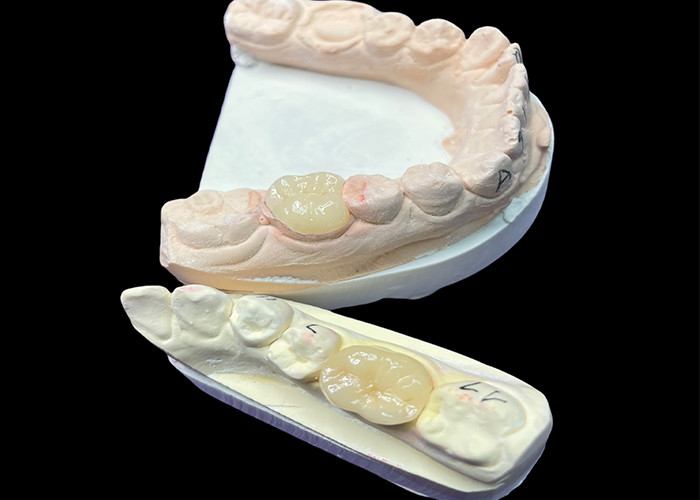 IPS e.max Ceramic Inlays and Onlays for Molar Restoration Naturalna estetyka i wyższa trwałość dla długotrwałych wyników