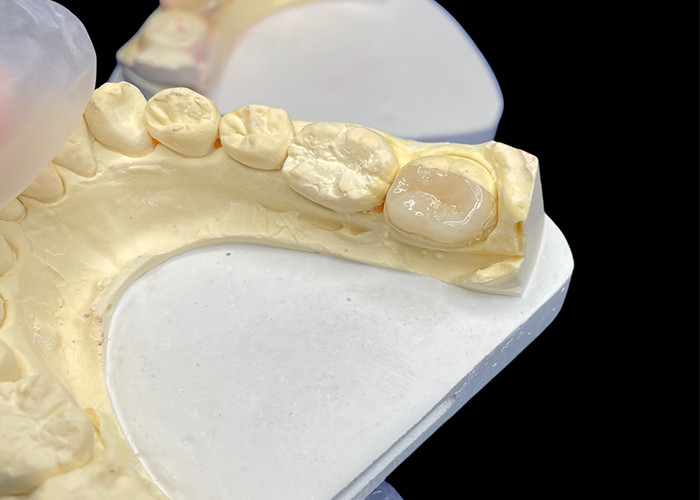 IPS e.max Ceramic Inlays and Onlays for Molar Restoration Naturalna estetyka i wyższa trwałość dla długotrwałych wyników