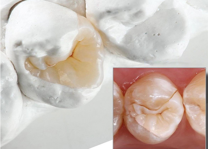 Naturalnie wyglądające ceramiczne wkładki i wkładki do precyzyjnej restauracji zębów z naszego eksperckiego laboratorium stomatologicznego