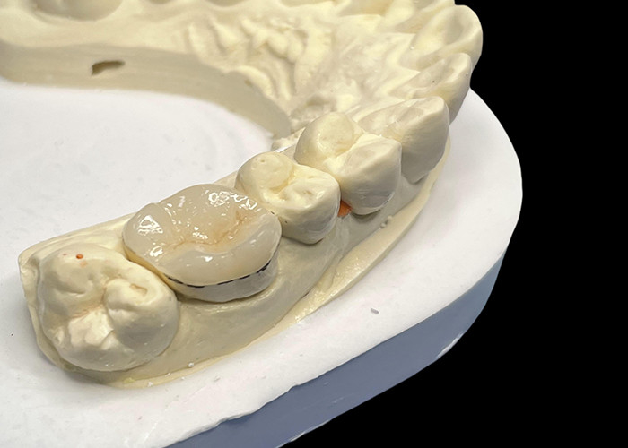 Niedoalergiczne wkładki z porcelany Wkładki do zębów Napraw naturalny kolor i łatwa konserwacja