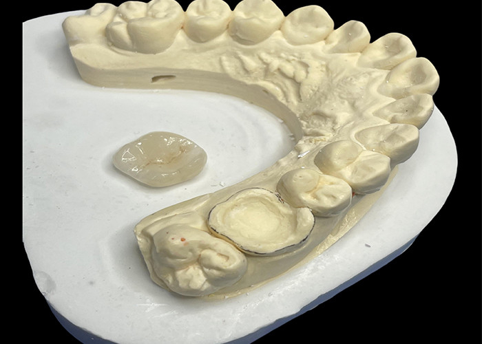 Keramiczne wkładki dentystyczne Onlay do efektywnej naprawy zębów z trwałych i estetycznych porcelanowych rozwiązań do długotrwałej restauracji
