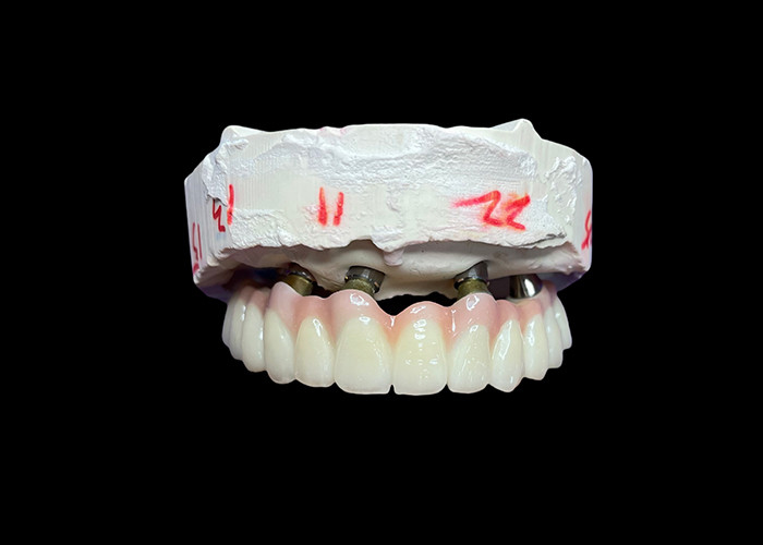 Zęby z implantami, złożone z pełnego łuku, zapewniające trwałe, stabilne i naturalne rozwiązanie problemu zębów.