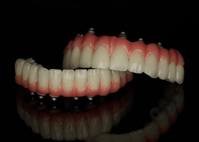 Tytanowa podstawa stały implant wspierane protezy z ceramiczne mostek korony Do zastąpienia brakujących zębów