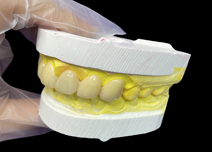 Kosmetyczna Vita Klasyczny odcień Ceramiczne korony i mosty z precyzyjnym naturalnym wyglądem i dostosowalnymi opcjami