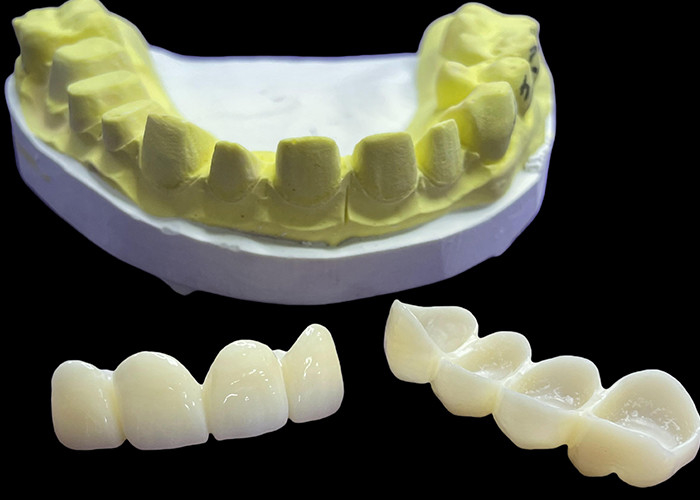 Korony i mosty z porcelany dentystycznej odpornej na plamy w Vita Klasyczne odcienie dla naturalnej estetyki