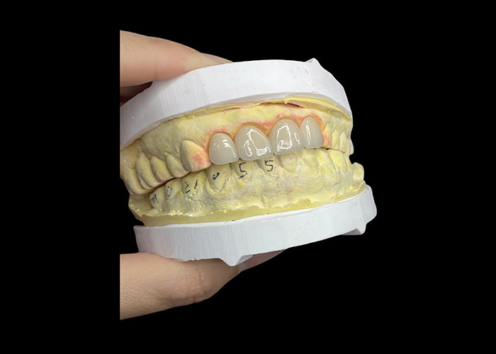 Korony i mosty z porcelany dentystycznej odpornej na plamy w Vita Klasyczne odcienie dla naturalnej estetyki