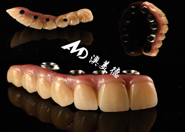 Naturalnie wyglądający implant zębowy most koronowy, zainstalowany z titanowym podłożem do operacji zębów.
