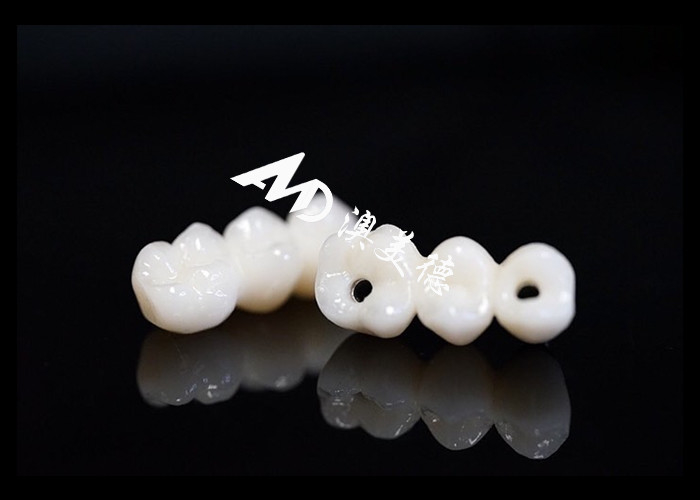 Naturalnie wyglądający implant zębowy most koronowy, zainstalowany z titanowym podłożem do operacji zębów.
