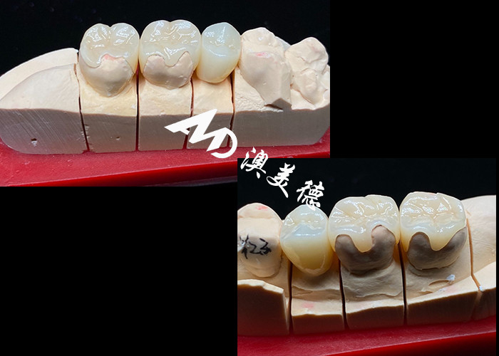 OEM Precision Fit Ceramic Inlays Onlays do trwałych i naturalnie wyglądających restauracji zębów o wyższej wytrzymałości i niezawodności
