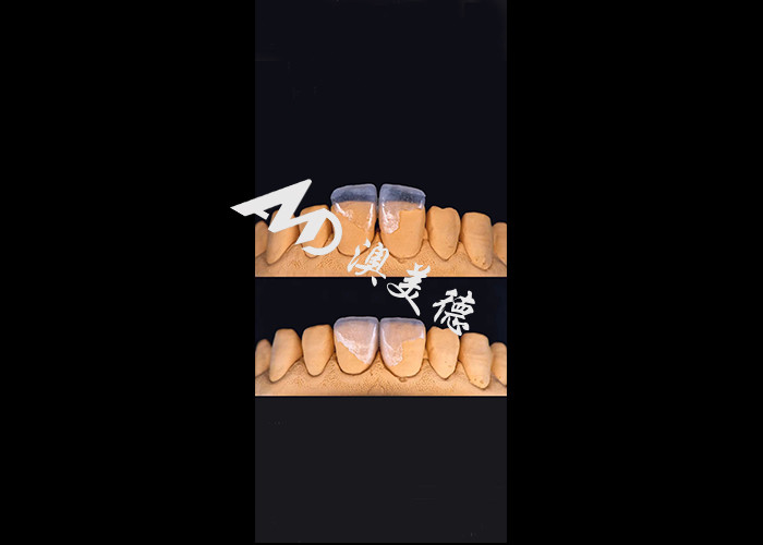 0.3-0.5mm Ultra Cienkie IPS EMAX Porcelanowe finery do estetycznego makijażu uśmiechu
