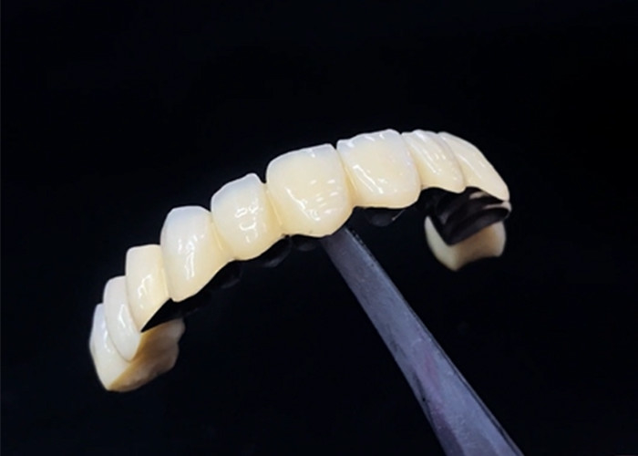 Porcelana stopiona do korony metalowej łącząca trwałość i piękno dla zdrowia zębów