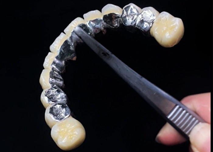 Porcelana stopiona do korony metalowej łącząca trwałość i piękno dla zdrowia zębów