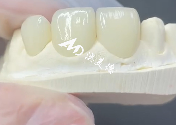 Trwałe i estetyczne finery EMAX doskonałe rozwiązanie dla restauracji porcelany