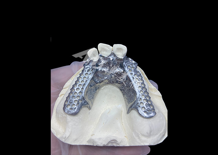 Łatwe dopasowanie Custom Cast Parcial Denture Stabilna i naturalnie wyglądająca ramka dla szybkich wyników