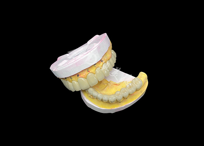 Niestandardowa porcelana stopiona z metalowym mostem korony dentystycznej dla naturalnego uśmiechu