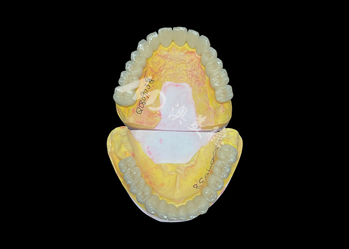 Niestandardowa porcelana stopiona z metalowym mostem korony dentystycznej dla naturalnego uśmiechu