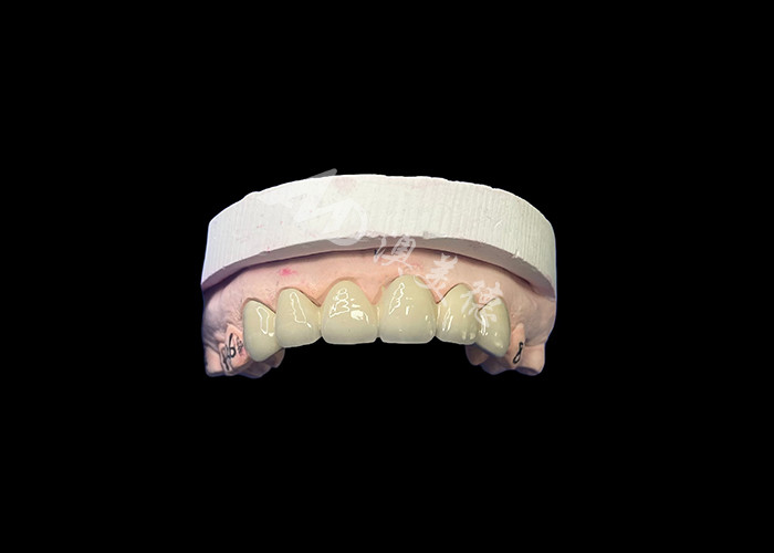Biokompatybilna porcelana stopiona z koroną metalową
