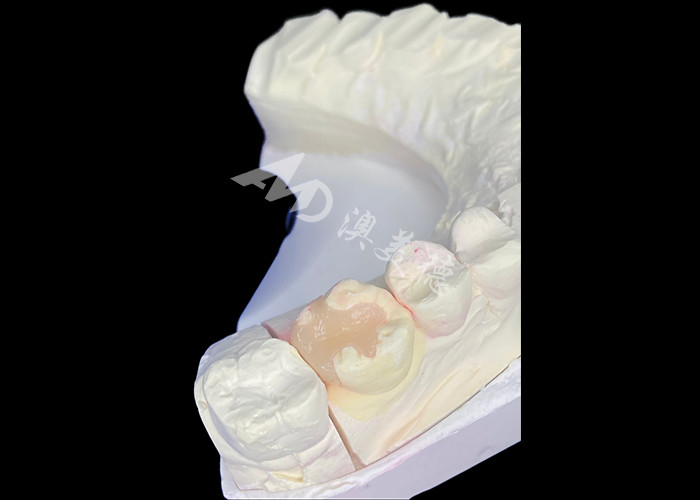 IPS e.max Ceramiczne wkładki i wkładki do odbudowy kły z trwałym efektem estetycznym i naturalnym