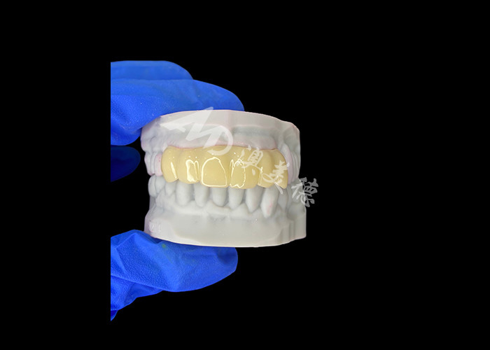 Lekkie Biokompatybilne Drukowane 3D Pustkowy Tymczasowy Mostek do Restauracji Przed Implantami