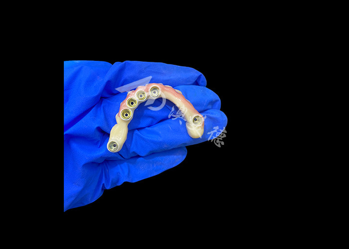 Tytanowa podszewka i cyrkoniowy implant korony