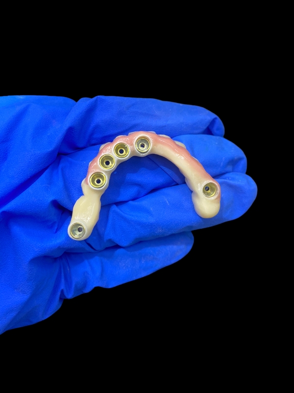 Tytanowa podszewka i cyrkoniowy implant korony