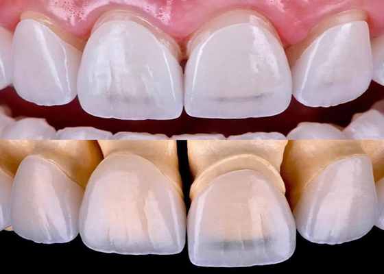 Dobra cena. Długotrwała folia dentystyczna EMAX wykonana ze wszystkich ceramicznych materiałów z cyrkonium w Internecie