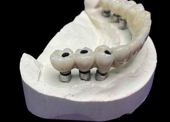 Dobra cena. Implant z tytanową podstawą jest pokryty piękną ceramiczną koroną, aby stworzyć doskonałą restaurację. w Internecie