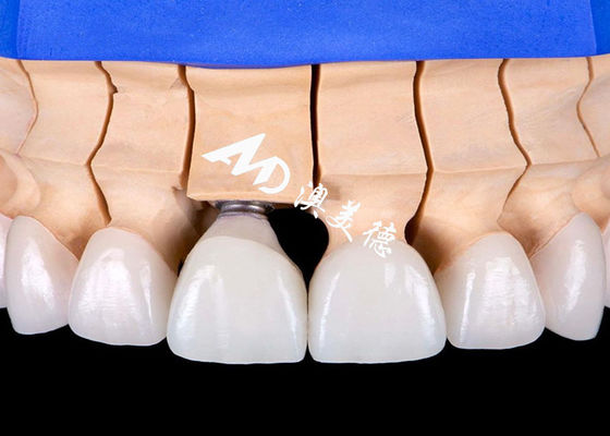 Dobra cena. Biokompatybilny implant złożony z stopów tytanu z naturalnym wyglądem w Internecie
